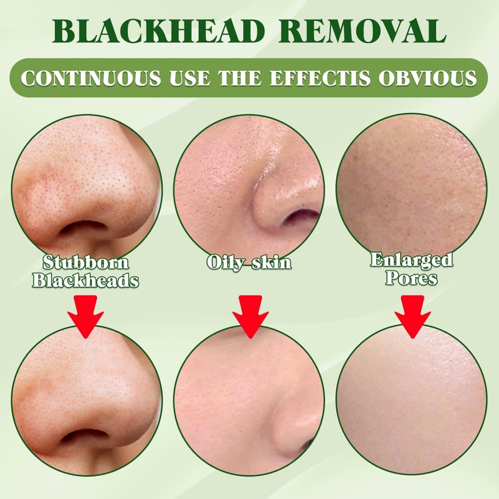 Pacote com 15 tiras removedora - Charcoal Pore Strip avaliação e preço